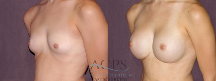 Before & After Breast Augmentation Case 904 Oblique Left View: View in Houston, TX