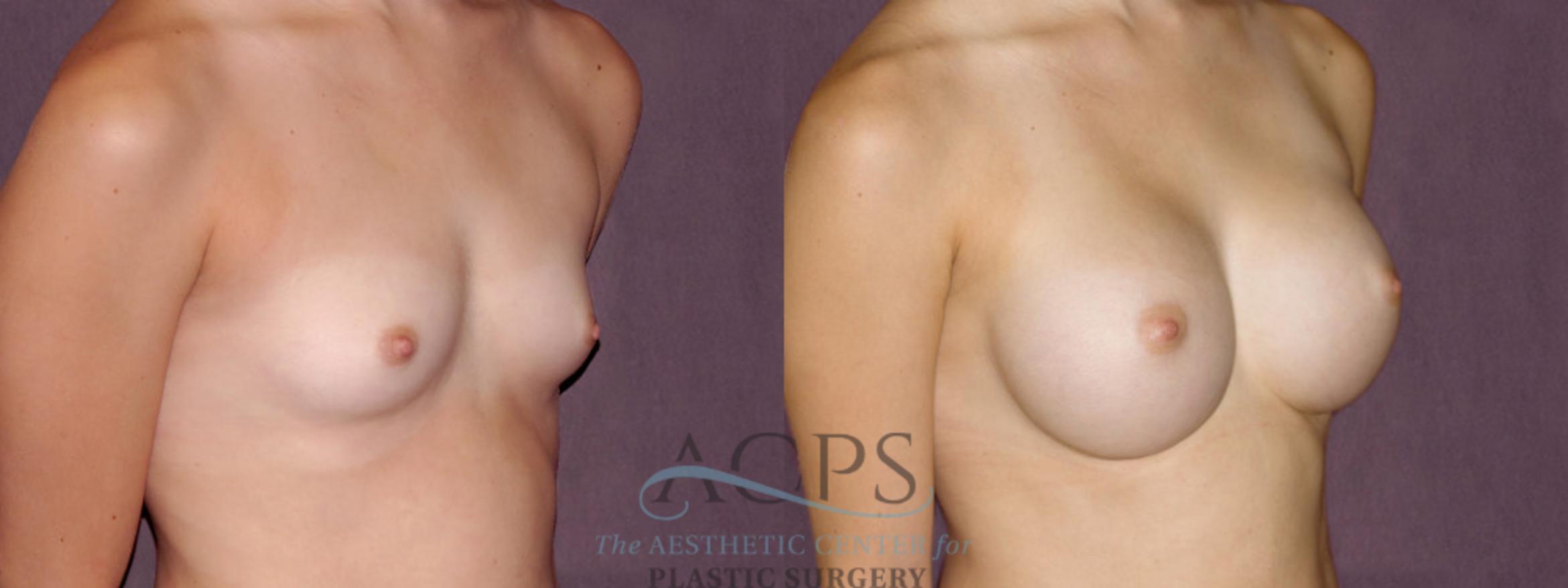 Before & After Breast Augmentation Case 904 Oblique Right View: View in Houston, TX