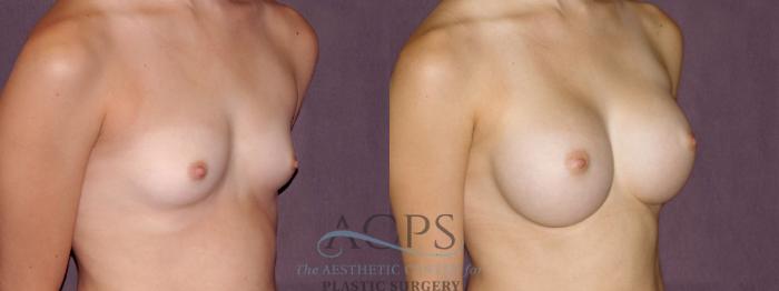 Before & After Breast Augmentation Case 904 Oblique Right View: View in Houston, TX