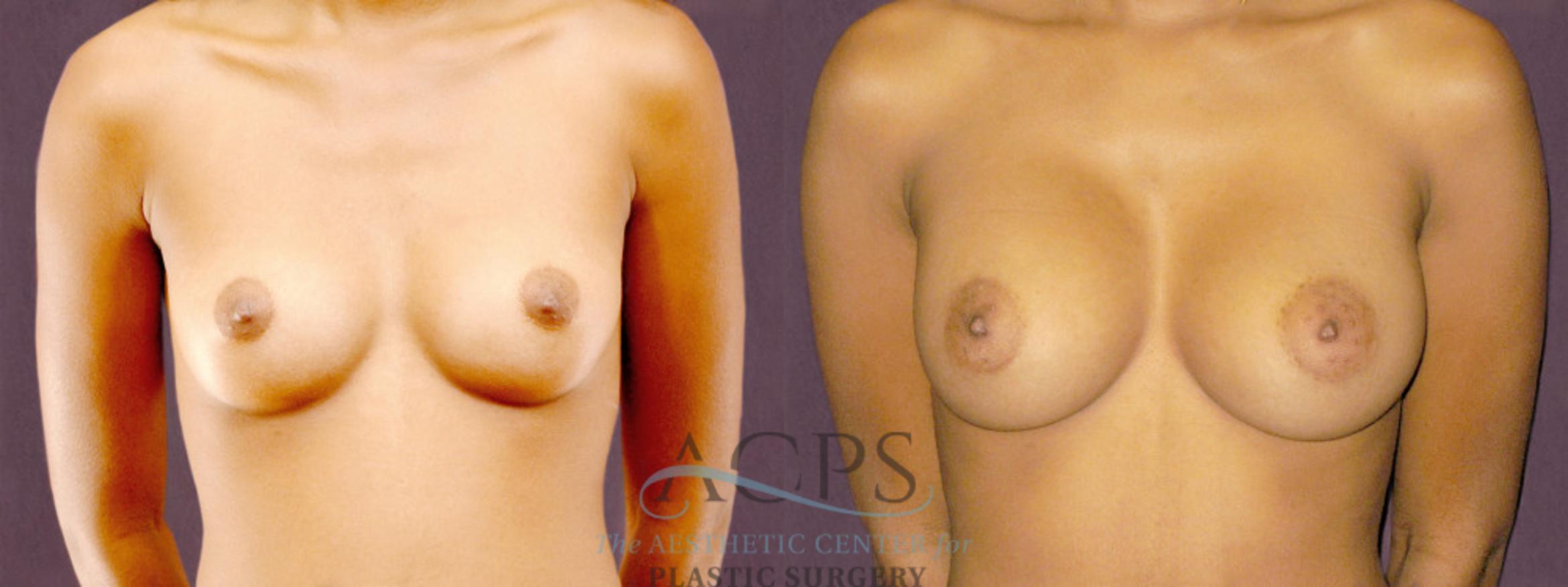 Before & After Breast Augmentation Case 905 Front View: View in Houston, TX