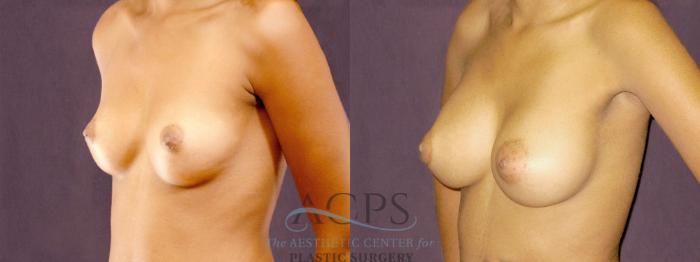 Before & After Breast Augmentation Case 905 Oblique Left View: View in Houston, TX