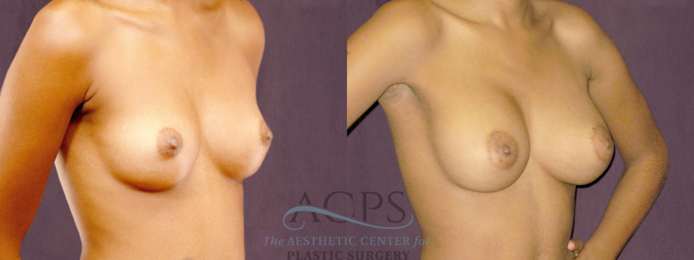 Before & After Breast Augmentation Case 905 Oblique Right View: View in Houston, TX