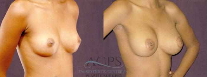 Before & After Breast Augmentation Case 905 Oblique Right View: View in Houston, TX