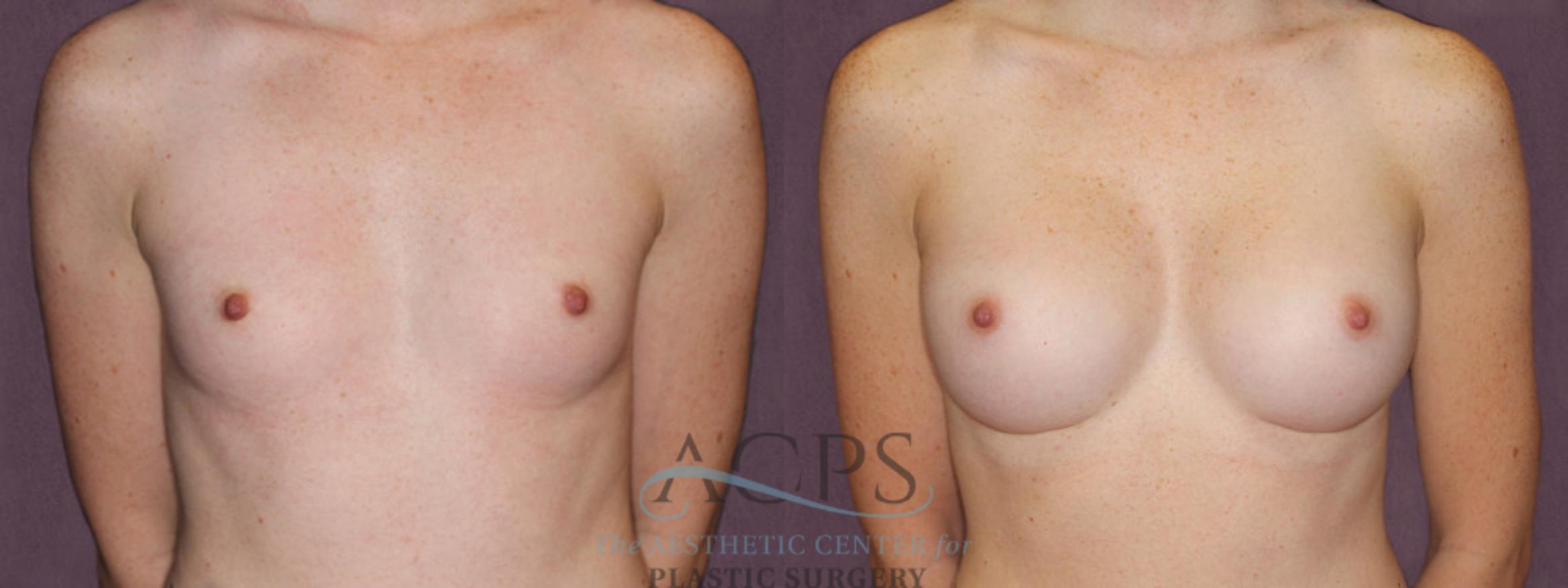Before & After Breast Augmentation Case 906 Front View: View in Houston, TX