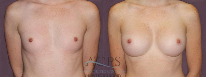 Before & After Breast Augmentation Case 906 Front View: View in Houston, TX