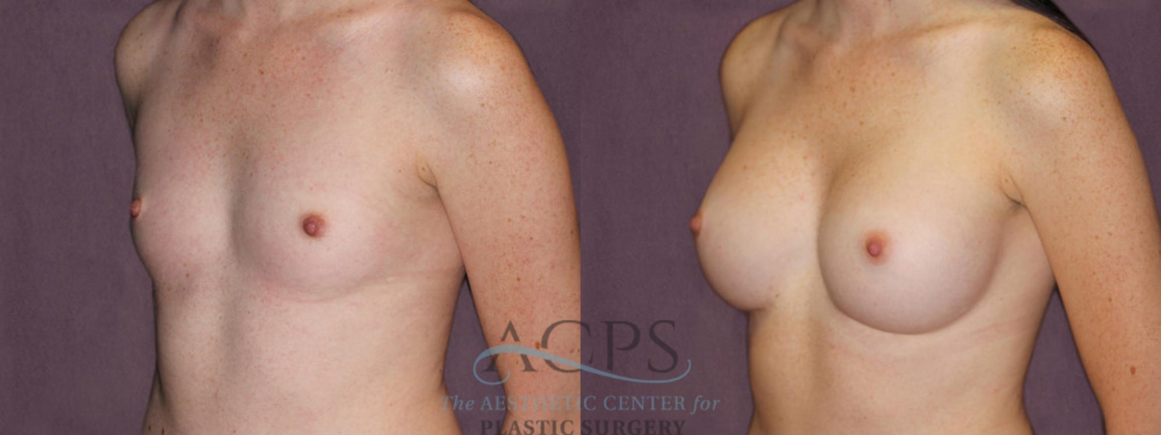 Before & After Breast Augmentation Case 906 Oblique Left View: View in Houston, TX