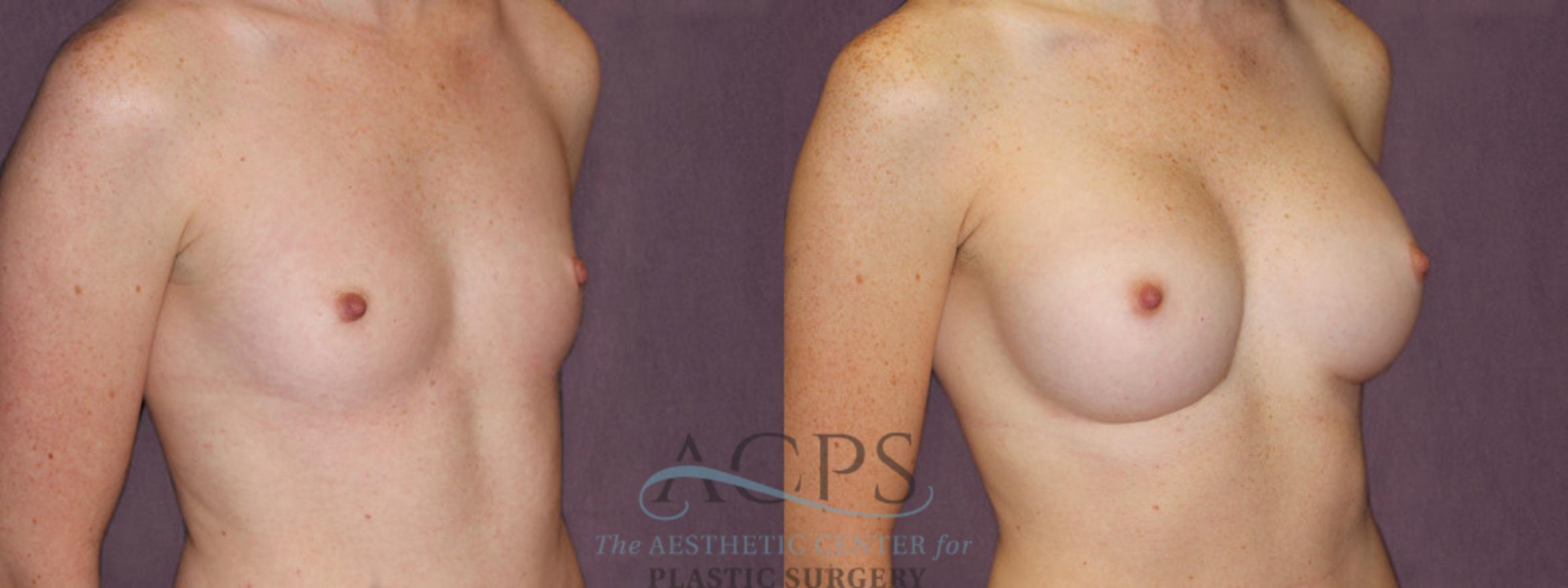 Before & After Breast Augmentation Case 906 Oblique Right View: View in Houston, TX