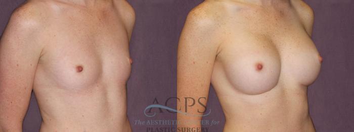 Before & After Breast Augmentation Case 906 Oblique Right View: View in Houston, TX