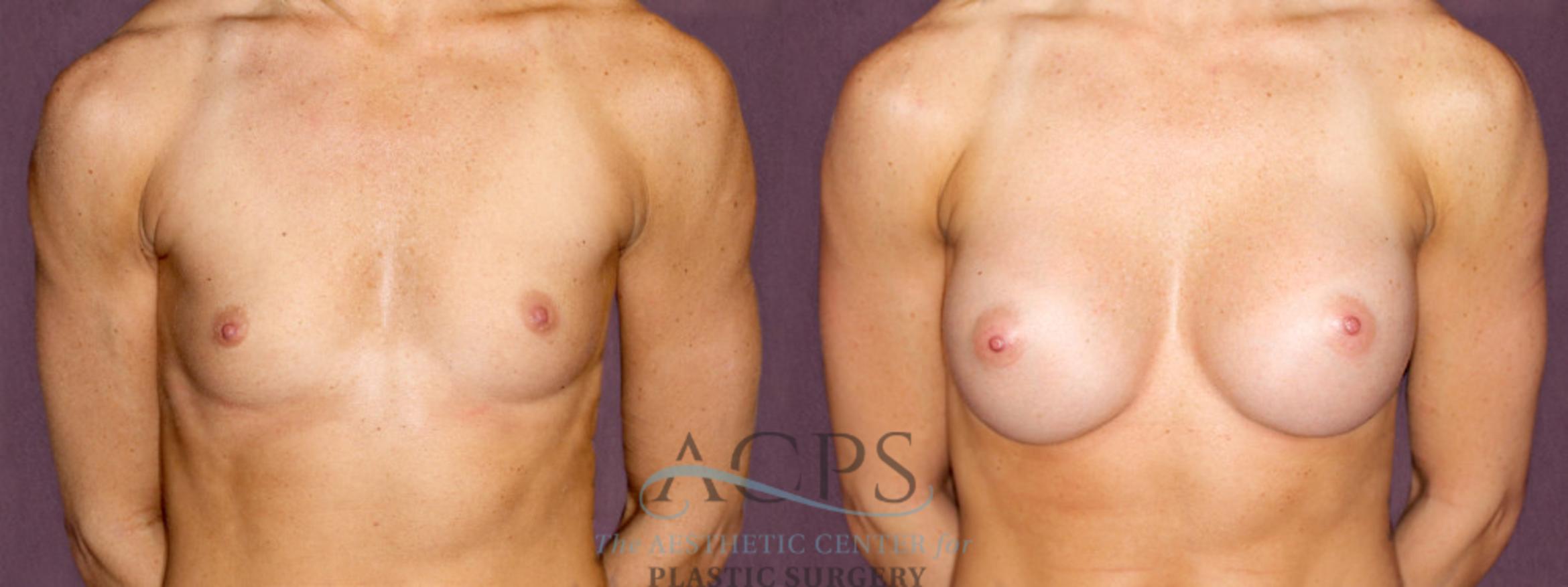 Before & After Breast Augmentation Case 907 Front View: View in Houston, TX
