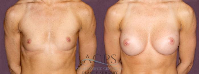 Before & After Breast Augmentation Case 907 Front View: View in Houston, TX