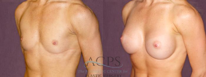 Before & After Breast Augmentation Case 907 Oblique Left View: View in Houston, TX