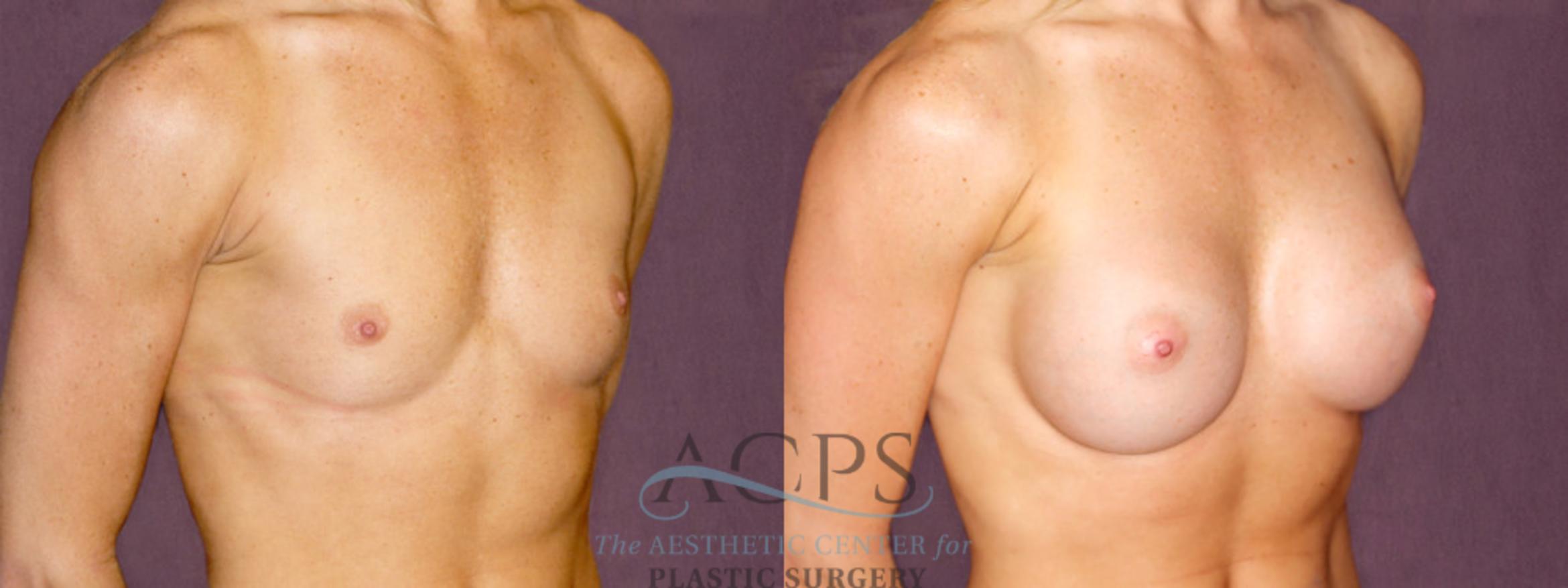 Before & After Breast Augmentation Case 907 Oblique Right View: View in Houston, TX