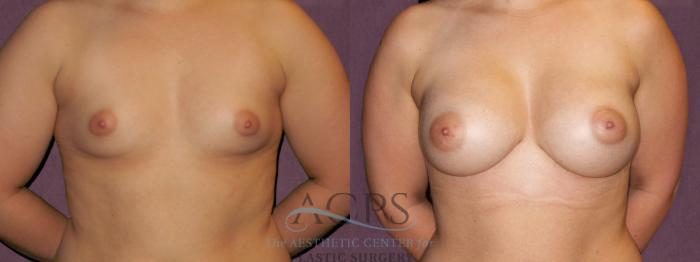 Before & After Breast Augmentation Case 908 Front View: View in Houston, TX