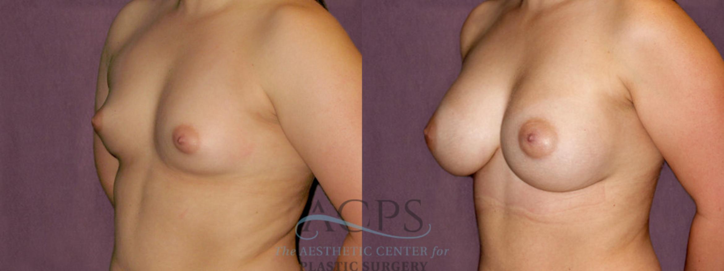 Before & After Breast Augmentation Case 908 Oblique Left View: View in Houston, TX
