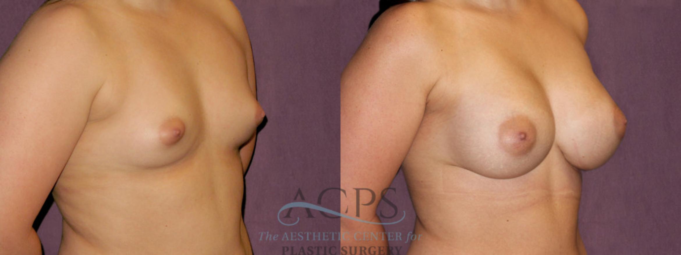 Before & After Breast Augmentation Case 908 Oblique Right View: View in Houston, TX