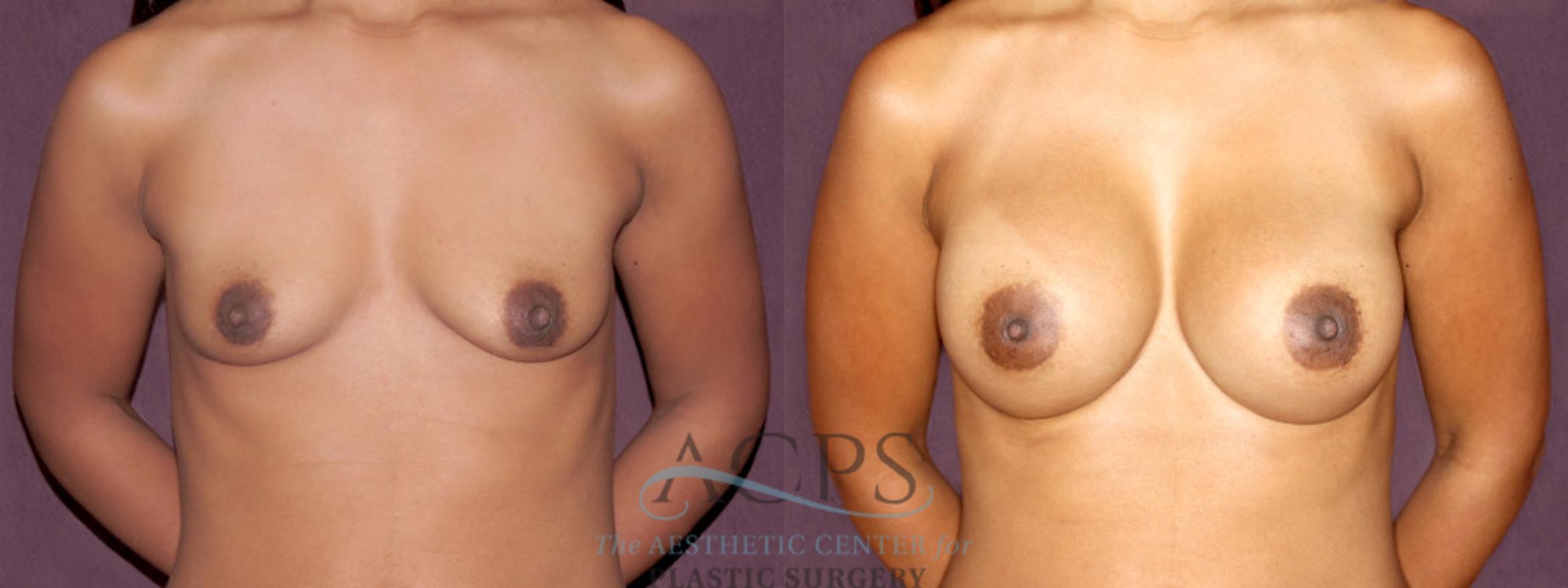 Before & After Breast Augmentation Case 909 Front View: View in Houston, TX