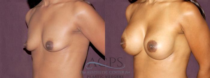 Before & After Breast Augmentation Case 909 Oblique Left View: View in Houston, TX