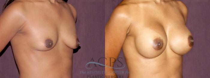 Before & After Breast Augmentation Case 909 Oblique Right View: View in Houston, TX