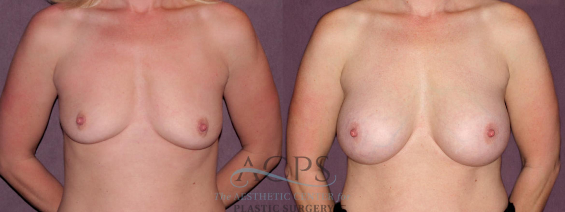 Before & After Breast Augmentation Case 910 Front View: View in Houston, TX