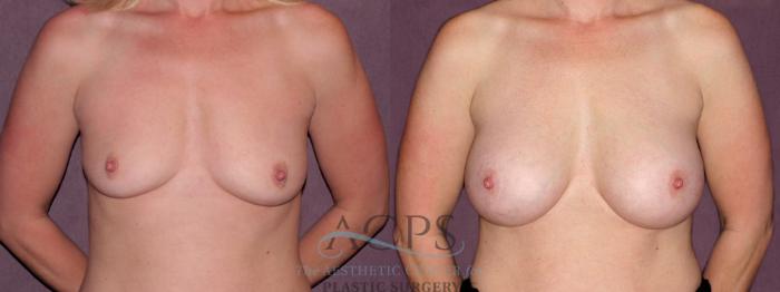 Before & After Breast Augmentation Case 910 Front View: View in Houston, TX