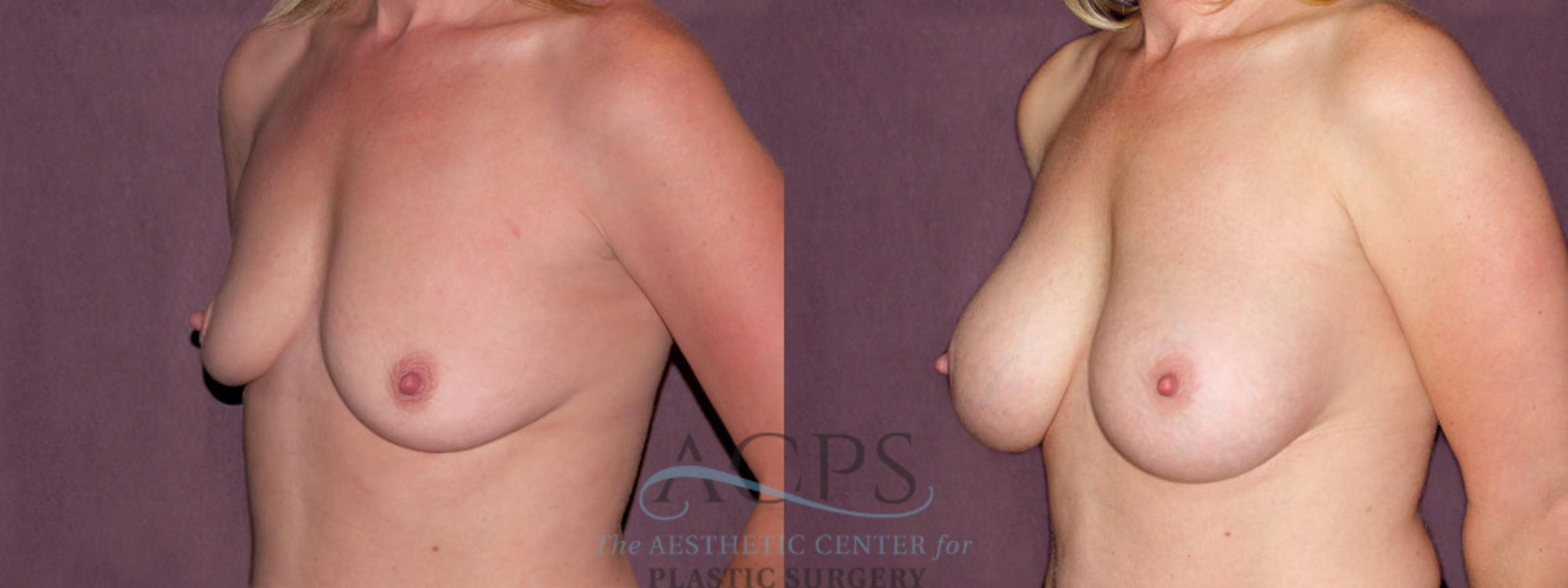 Before & After Breast Augmentation Case 910 Oblique Left View: View in Houston, TX