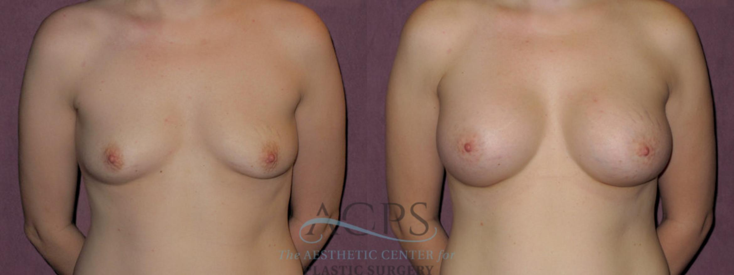 Before & After Breast Augmentation Case 911 Front View: View in Houston, TX