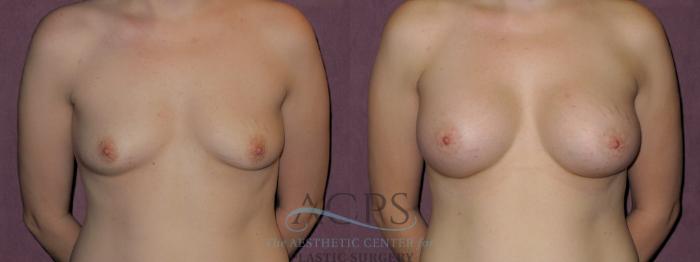 Before & After Breast Augmentation Case 911 Front View: View in Houston, TX