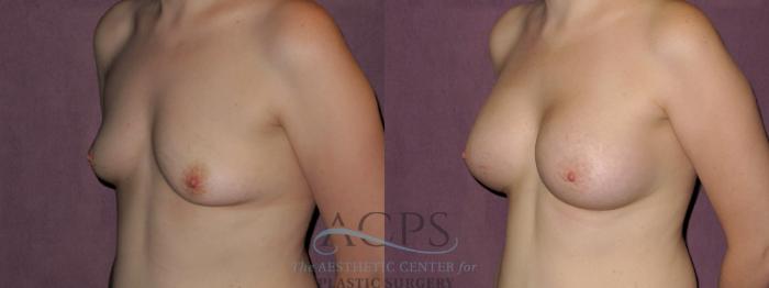 Before & After Breast Augmentation Case 911 Oblique Left View: View in Houston, TX