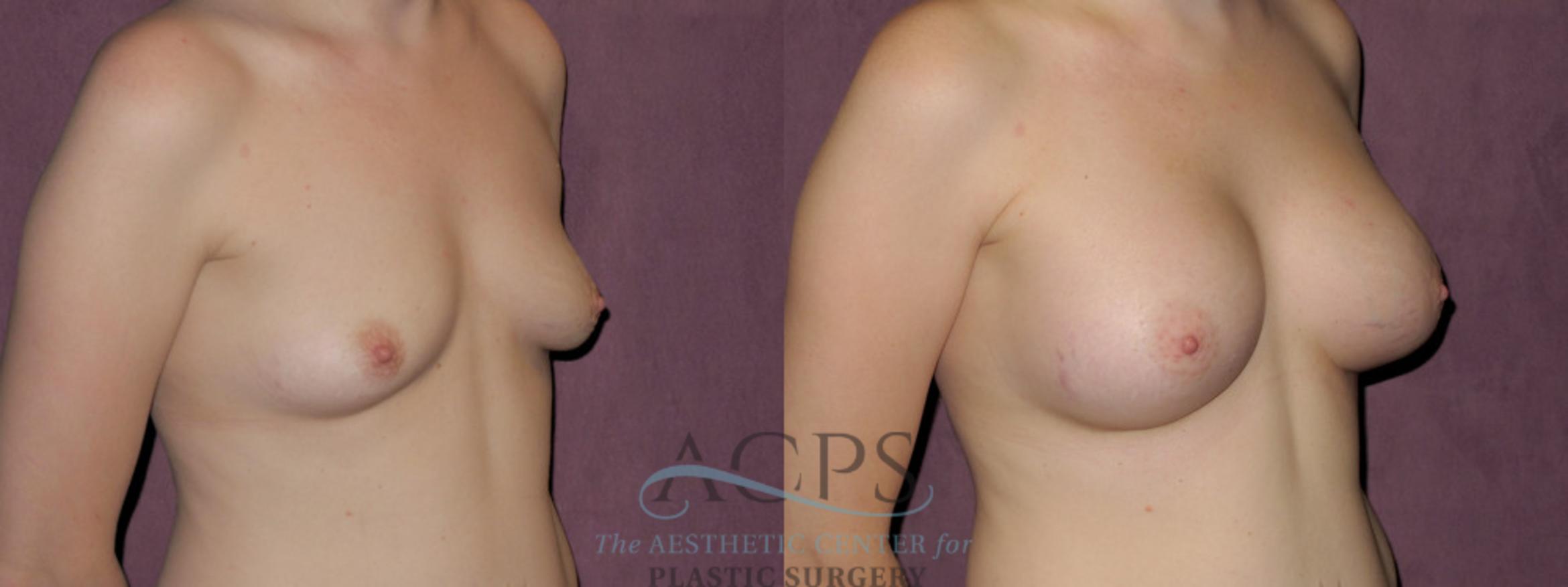Before & After Breast Augmentation Case 911 Oblique Right View: View in Houston, TX