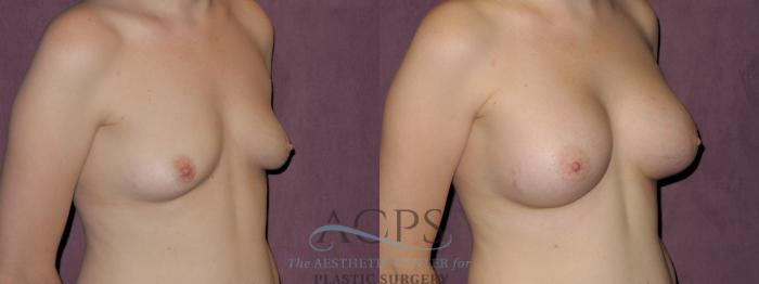 Before & After Breast Augmentation Case 911 Oblique Right View: View in Houston, TX