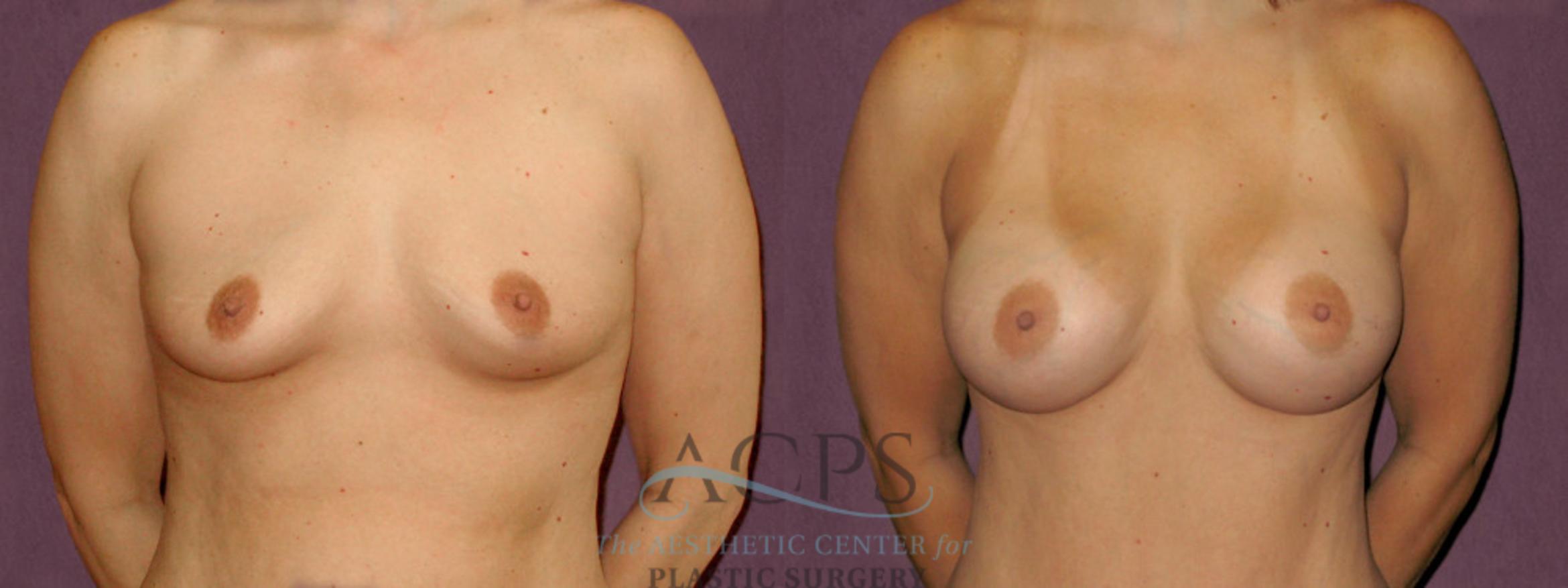 Before & After Breast Augmentation Case 912 Front View: View in Houston, TX