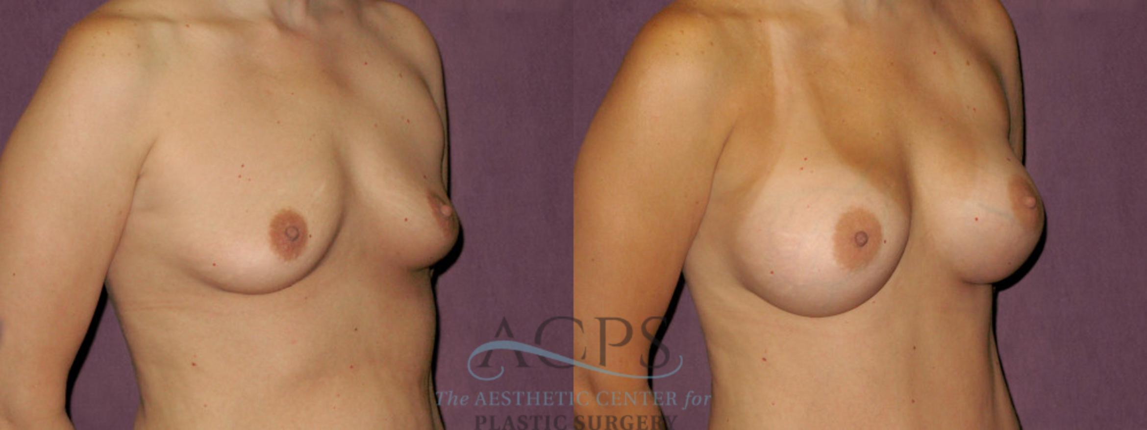 Before & After Breast Augmentation Case 912 Oblique Right View: View in Houston, TX