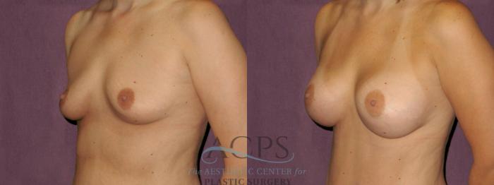 Before & After Breast Augmentation Case 912 Side Left View: View in Houston, TX