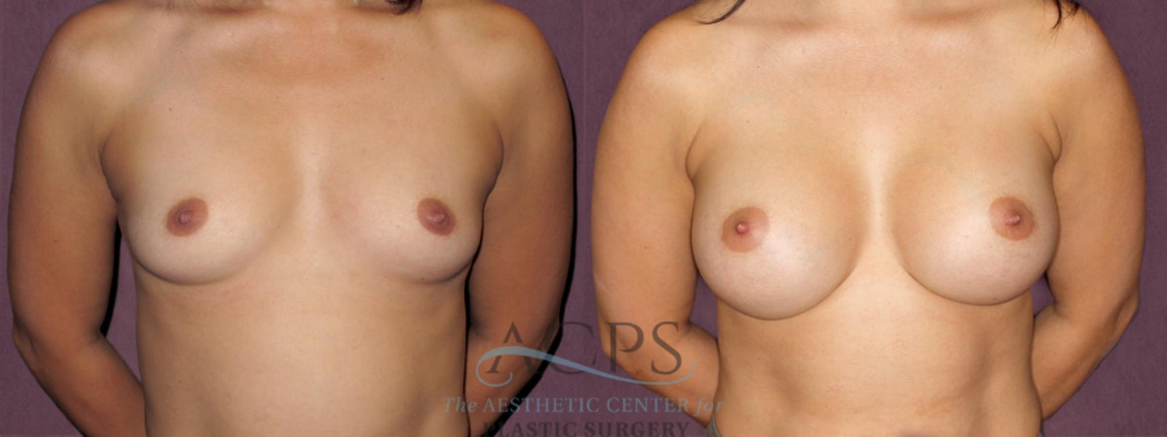 Before & After Breast Augmentation Case 913 Front View: View in Houston, TX