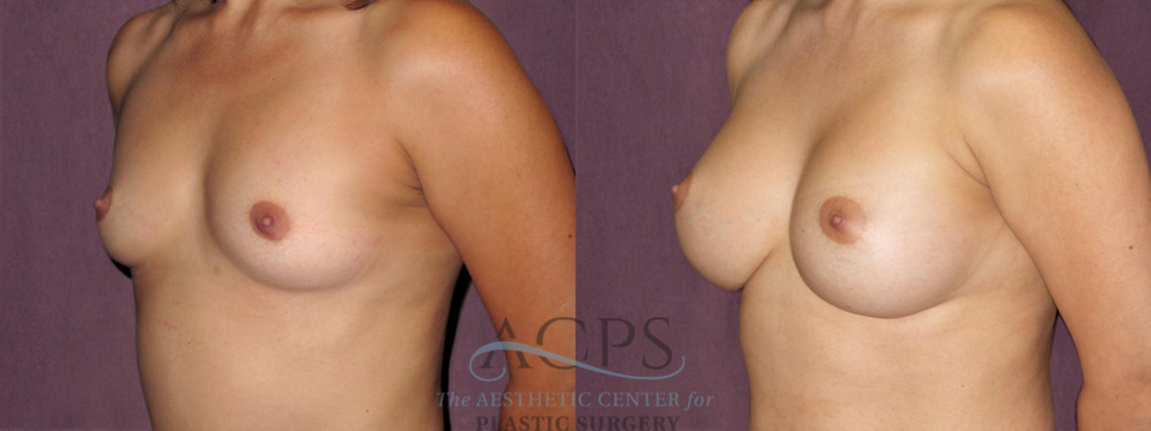 Before & After Breast Augmentation Case 913 Oblique Left View: View in Houston, TX
