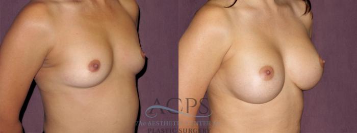 Before & After Breast Augmentation Case 913 Oblique Right View: View in Houston, TX