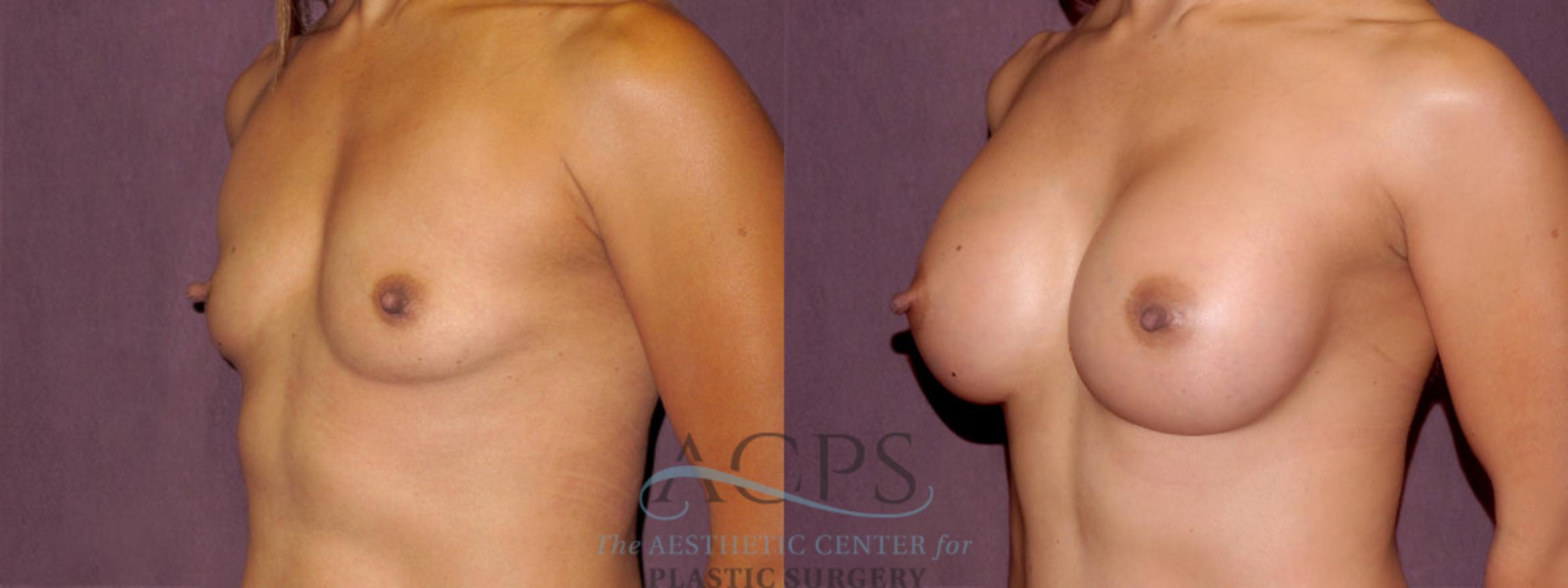 Before & After Breast Augmentation Case 914 Oblique Left View: View in Houston, TX