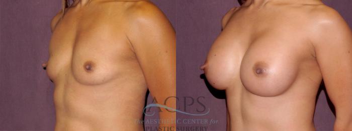 Before & After Breast Augmentation Case 914 Oblique Left View: View in Houston, TX