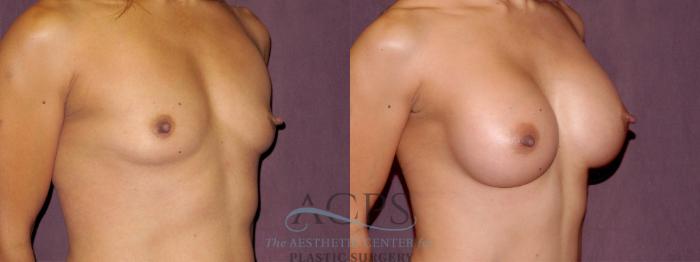 Before & After Breast Augmentation Case 914 Oblique Right View: View in Houston, TX