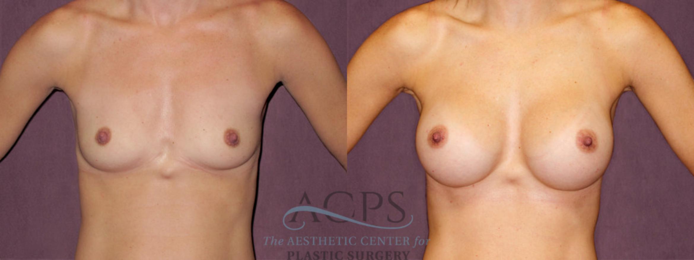 Before & After Breast Augmentation Case 915 Front View: View in Houston, TX