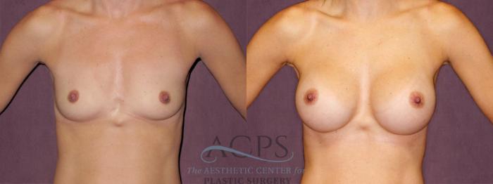 Before & After Breast Augmentation Case 915 Front View: View in Houston, TX