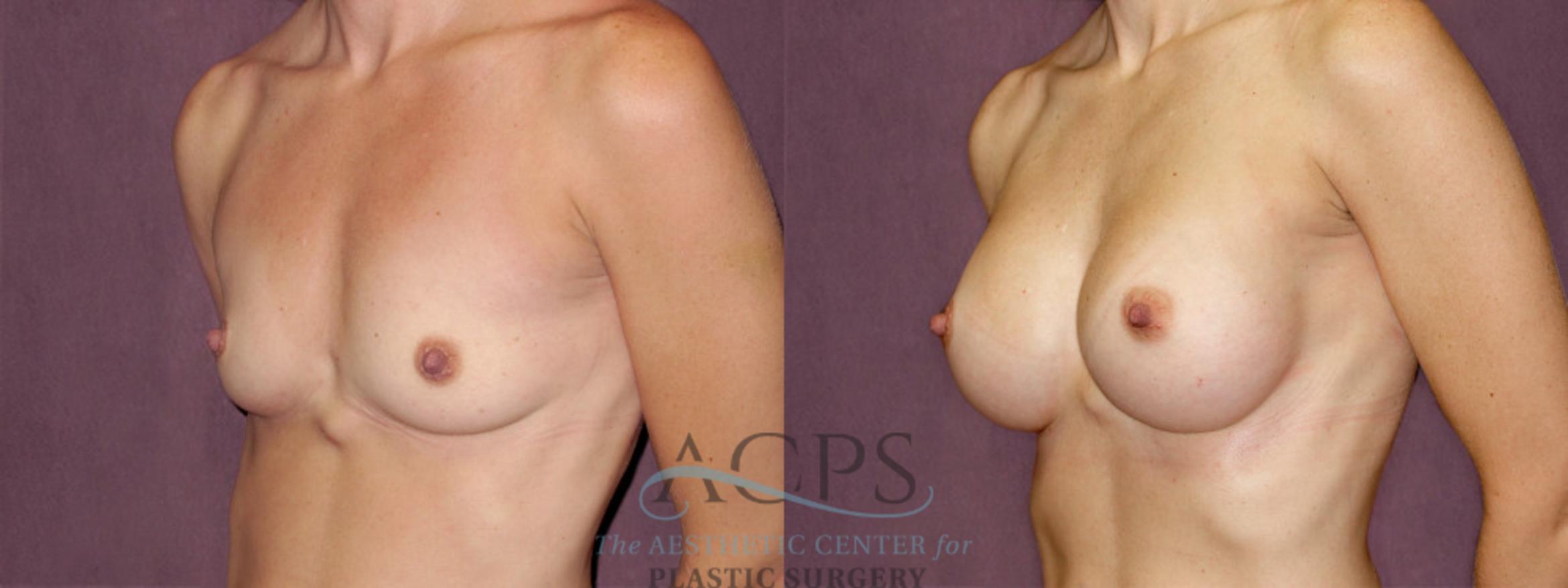 Before & After Breast Augmentation Case 915 Oblique Left View: View in Houston, TX