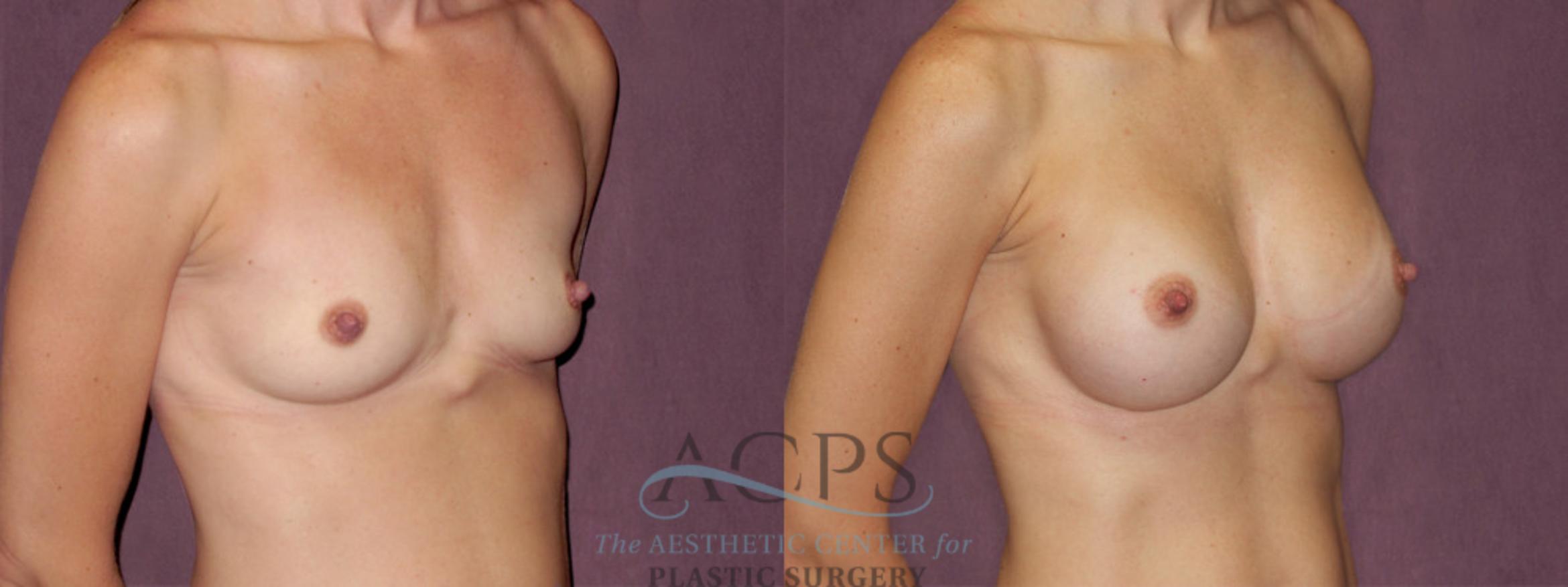 Before & After Breast Augmentation Case 915 Oblique Right View: View in Houston, TX