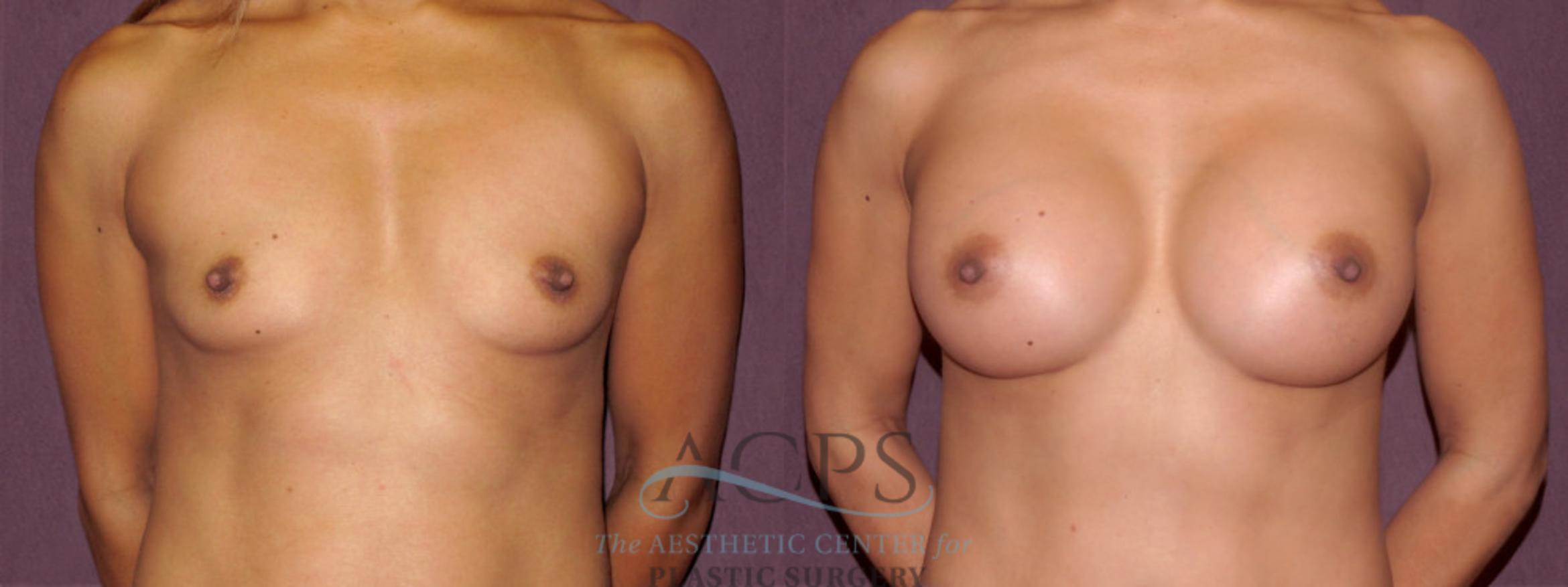 Before & After Breast Augmentation Case 917 Front View: View in Houston, TX