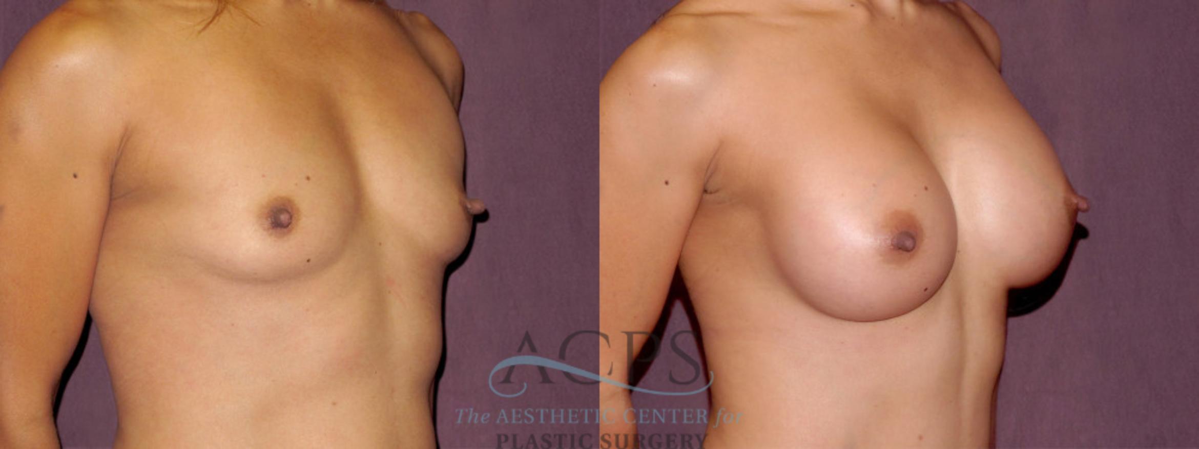 Before & After Breast Augmentation Case 917 Oblique Right View: View in Houston, TX
