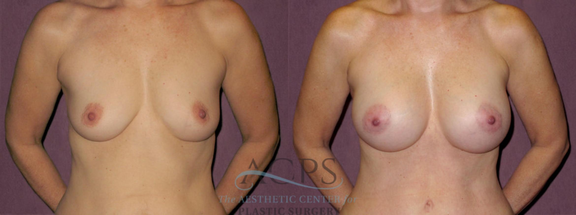 Before & After Breast Augmentation Case 918 Front View: View in Houston, TX