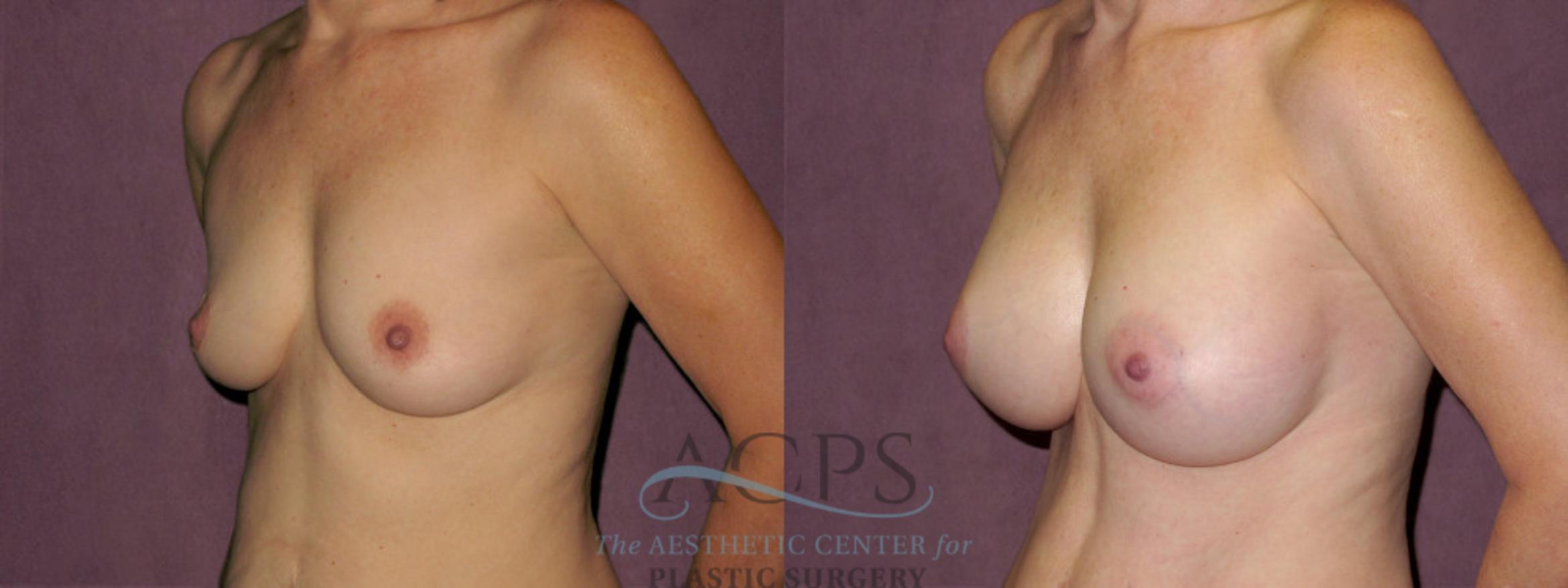 Before & After Breast Augmentation Case 918 Oblique Left View: View in Houston, TX