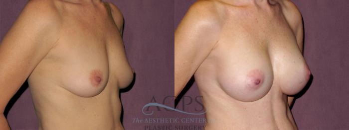 Before & After Breast Augmentation Case 918 Oblique Right View: View in Houston, TX