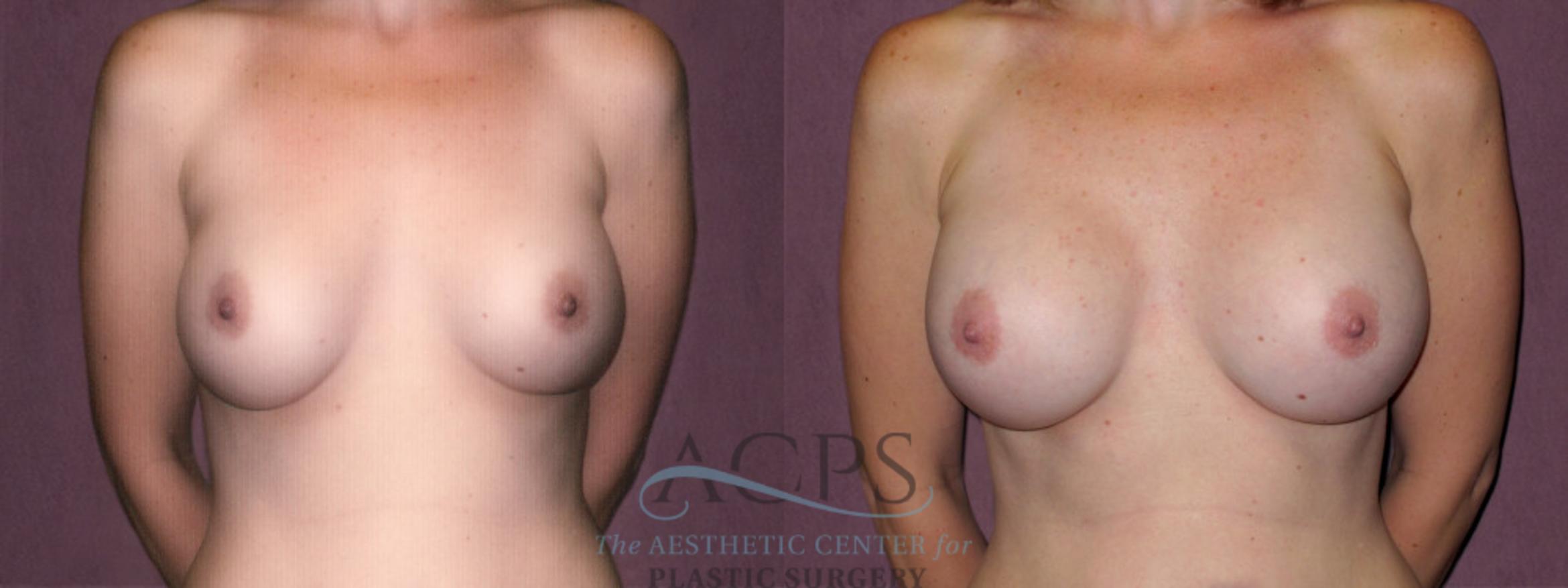 Before & After Breast Augmentation Case 919 Front View: View in Houston, TX