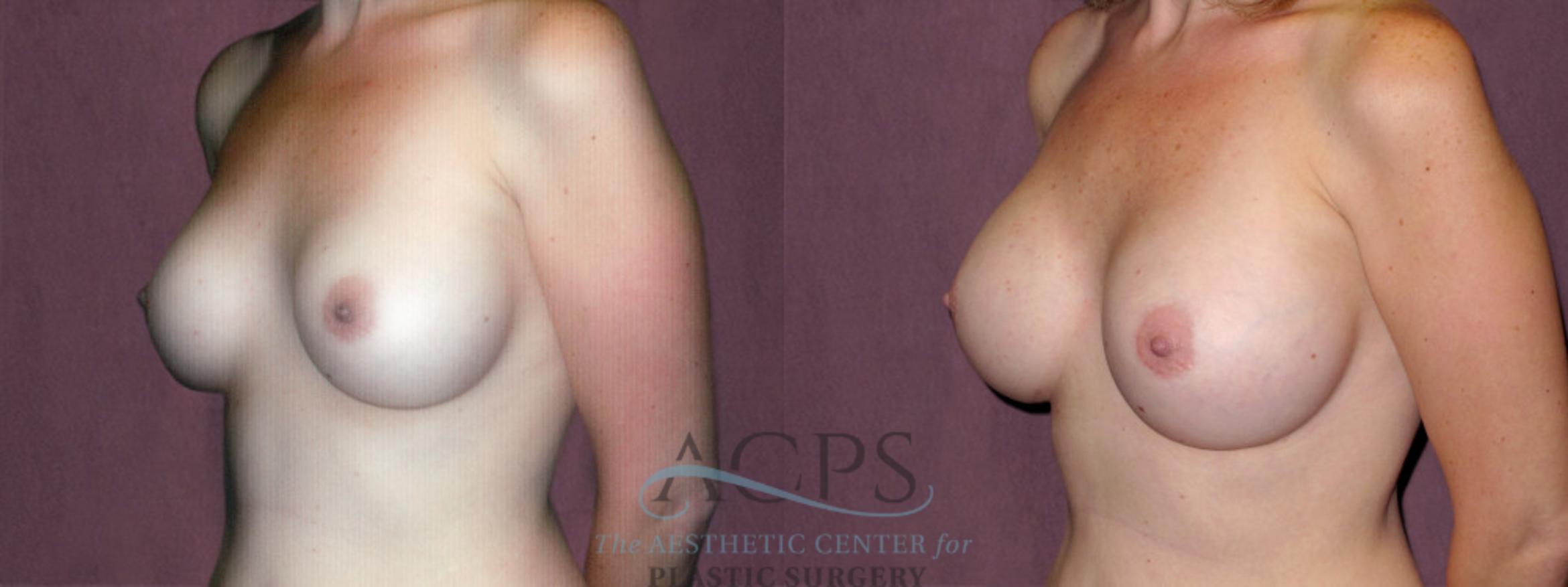 Before & After Breast Augmentation Case 919 Oblique Left View: View in Houston, TX